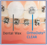 Orthodots - brace wax alternative. – Queensway Orthodontics